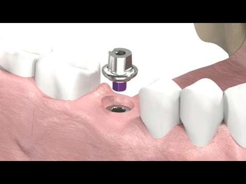image-Are dental implants considered prosthetics?