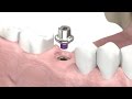 SIC invent Dental Implant - Prosthetic Animation: Single Crown (Closed Tray Technique)