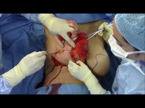 Taba kababaihan at lumago manipis Ang pinakamahusay na paraan upang alisin cellulite