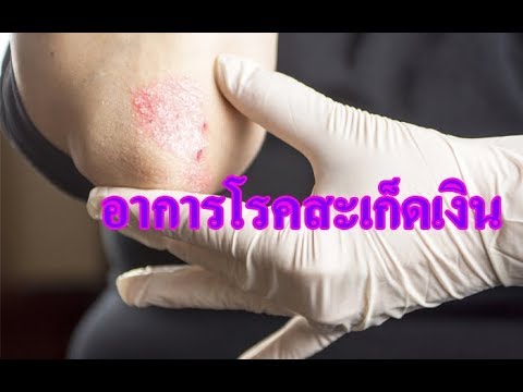 Ladoshechno ภาพฝ่าเท้าโรคสะเก็ดเงิน Naftalan ครีมกลาก
