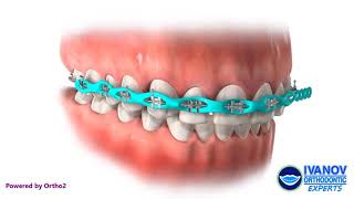 Braces Light Blue Color Powerchain