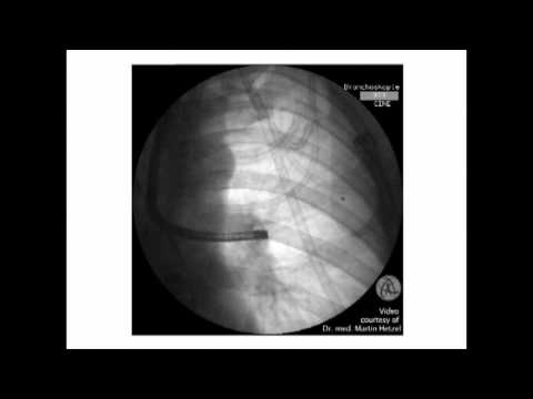 Neue Therapie bei schwerem Lungenemphysem