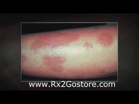 Invalidità al bambino su dermatite atopic Dermatite di atopic come eczema
