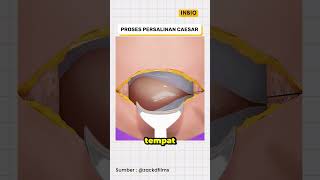 Download lagu Caesarean section process mp3