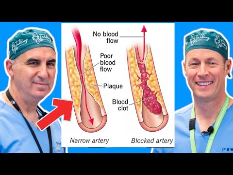 Peripheral Arterial Disease: Symptoms, Risks, and Treatments