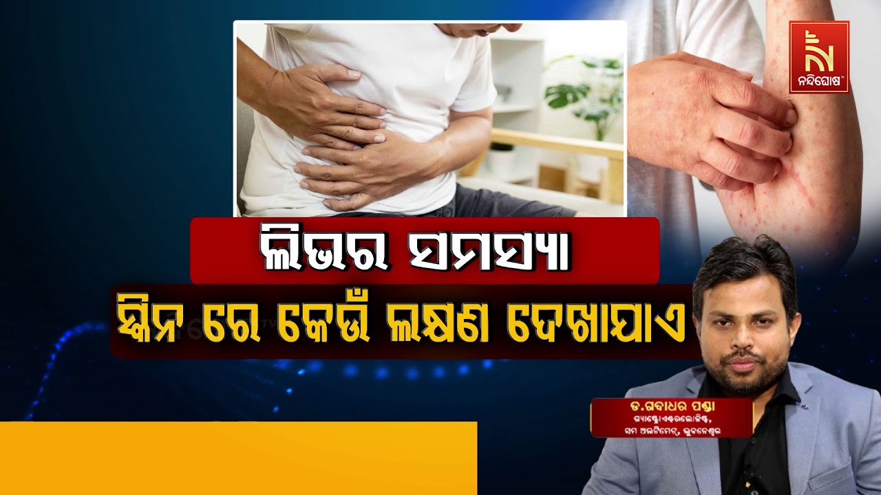 Liver Cirrhosis and Its Impact on Skin: Symptoms | Dr. Gadadhara Panda | Swasthyasutra
