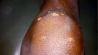 Multiple pus boils over the leg