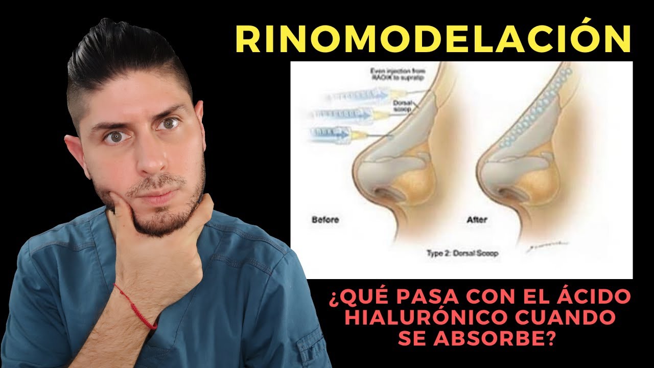 ¿Qué pasa cuando el ÁCIDO HIALURÓNICO se absorbeI RINOMODELACIÓN I DOCTOR LEMUS