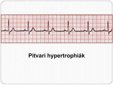 Aorta hipertónia