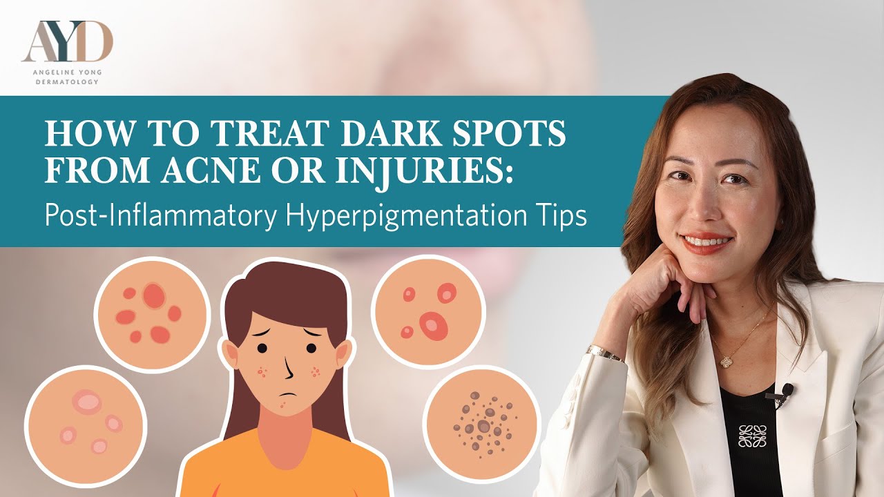 Say Goodbye to Dark Spots: Effective Tips for Treating Post-Inflammatory Hyperpigmentation