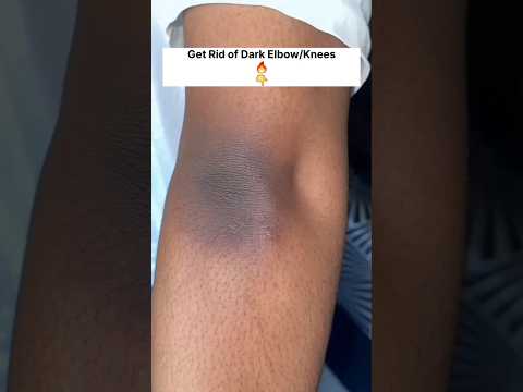 🔥Dark Elbow Home Remedies | Get Rid of Dark Elbow/Knees🤩#skincare#dark#shorts#viral#viralvideo#short
