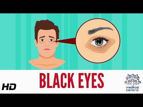 Black Eye, Causes, Signs and Symptoms, Diagnosis and Treatment