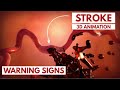 How To Recognize A Stroke 3D Animation