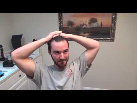 
Dr. Brett Bolton patient Casey FUE Correction Part #1


