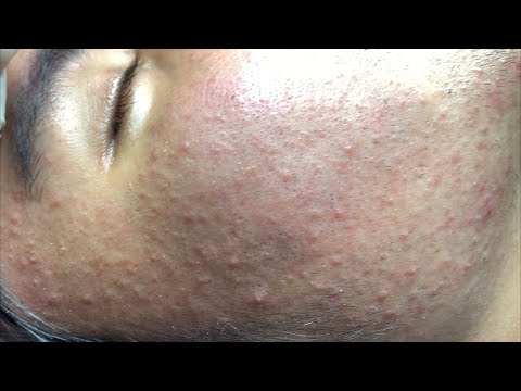Satisfying Hien Spa Beauty Relaxing Video #26