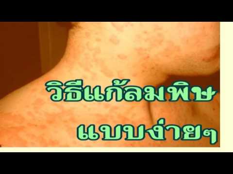 ระคายเคืองสำหรับการรักษาโรคสะเก็ดเงิน ทำให้เกิดอาการโรคสะเก็ดเงิน