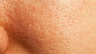 ¿Cómo eliminar los poros abiertos / Tips para eliminar la piel grasa