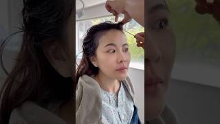 태국 고객님의 모발이식 리얼 후기 🇹🇭💙