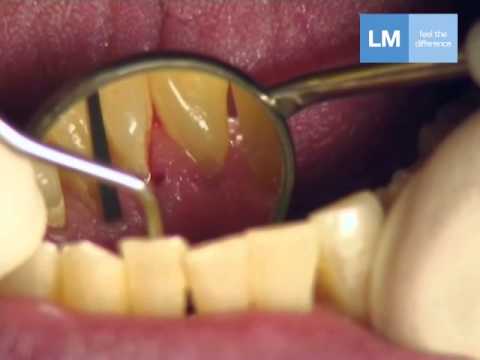 Cum folosesti instrumentarul HOE SCALER LATERAL 134-135XSI LM Dental