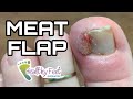 Ingrown Nail with Meat Flap