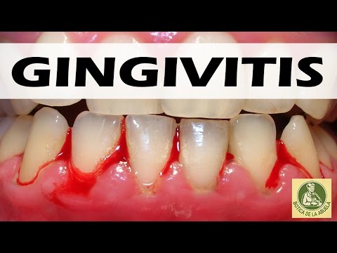 Remedios caseros para la gingivitis