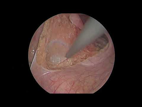Rectopexia anterior laparoscópica
