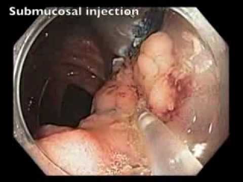 EMR of a Large Tumor in a Transverse Colon