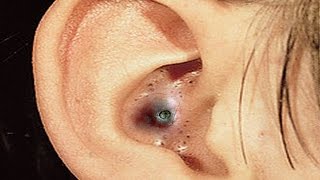 Blackhead Popping;  Should You Wear Gloves?