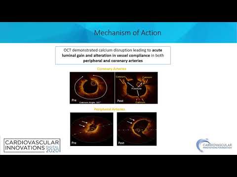 Lithotripsy for vascular access- Alan Zajarias