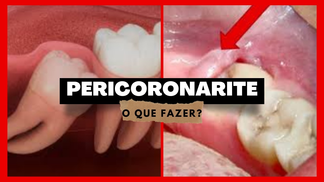 Pericoronarite.  O que é?