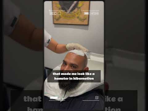 I used all my luck to find this clinic for my hair transplant!