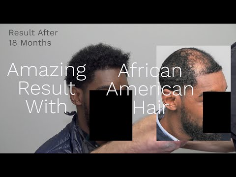 African American Patient With Amazing Hair Transplant...