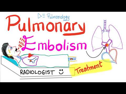 Pulmonary Embolism (PE) - Treatment - Thromboembolism - Pulmonology Playlist