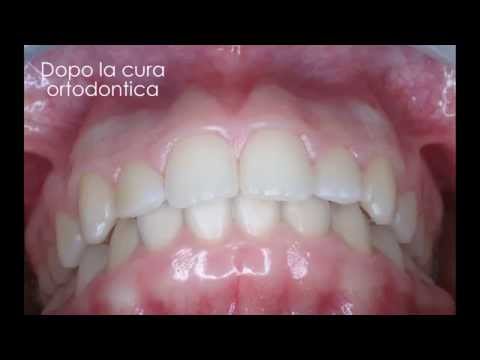 Bardana lascia proprietà e controindicazioni medicinali ginocchio Calendario lunare per le articolazioni dellanca