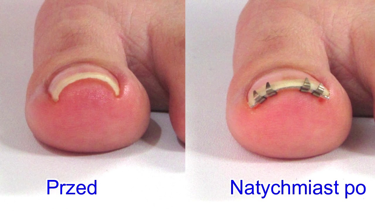 Polish v2: Procedura „NailLift” wrośniętego korektora paznokci
