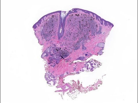 Deep penetrating and combined nevi Phi;;ip McKee, Michael Cardis,  George Balis