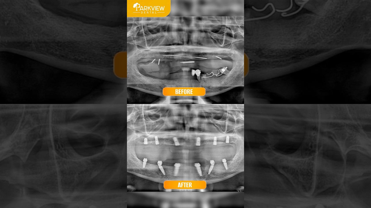 Mất Răng Toàn Hàm Gây Tiêu Xương – Giải Pháp Phục Hồi Ăn Nhai & Nụ Cười Tại Parkview Dental