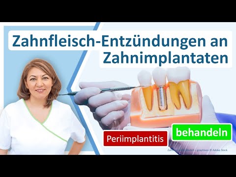 Zahnfleischentzündung und Parodontose an Zahnimplantaten? Zahnarzt Großostheim, Praxis N. Redjai