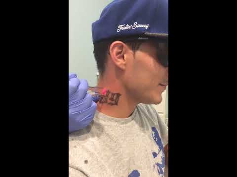 download lagu mp3 mp4 Tattoo Removal Austin, download lagu Tattoo Removal Austin gratis, unduh video klip Tattoo Removal Austin