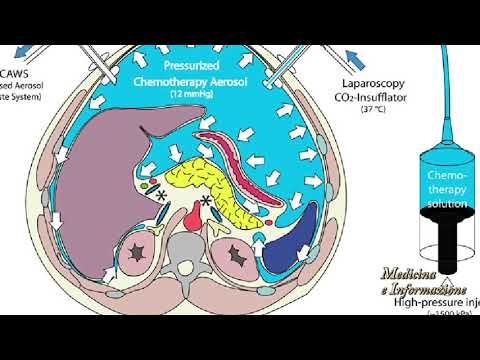 Come scegliere il cuscino giusto con osteocondrosi cervicale Mal di schiena riflessa