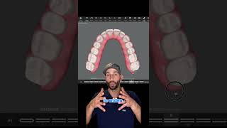 Using Invisalign to widen a patient’s smile and correct their “Bugs Bunny” front teeth.