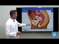 Female Bladder Leakage Solutions To Get Control‎ Christopher Tarnay MD UCLAMDChat