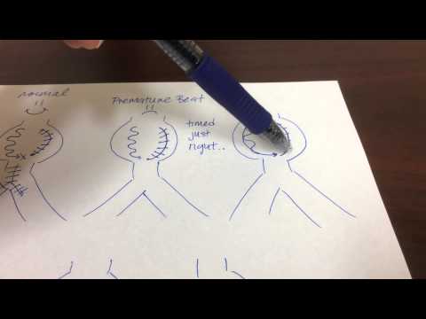 AVNRT AV Nodal Reentrant Tachycardia Interventional Cardiology Electrophysiology Cardiac Pacing