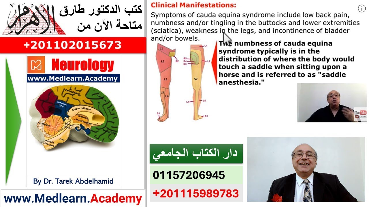 Cauda Equina Syndrome #neurology  #usmle #internal_medicine #cme   #ecg # محاضرات_باطنة