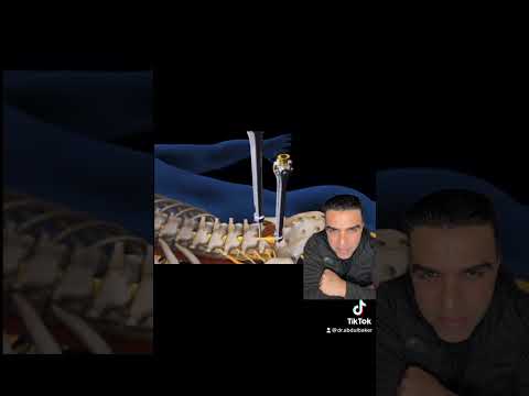 Animation, lumbar fusion #Spine #Neurosurgery #Neurosurgeon #Fusion #Health #Wellness #BackPain