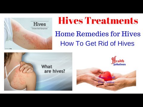 How to treat hives - Hives Treatments - Home Remedies for Hives Video