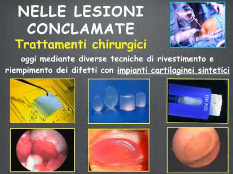 Intervento chirurgico al ginocchio in recensioni Mosca Tao ginocchio trattamento 1 grado