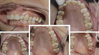 Sử dụng loop chữ nhật để lún răng đối tạo khoảng phục hình cho implant