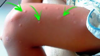 Veja Porque Os Mosquitos Picam Você E Não Os Outros