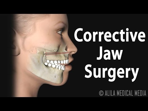 Corrective Jaw (Orthognathic) Surgery, Animation.